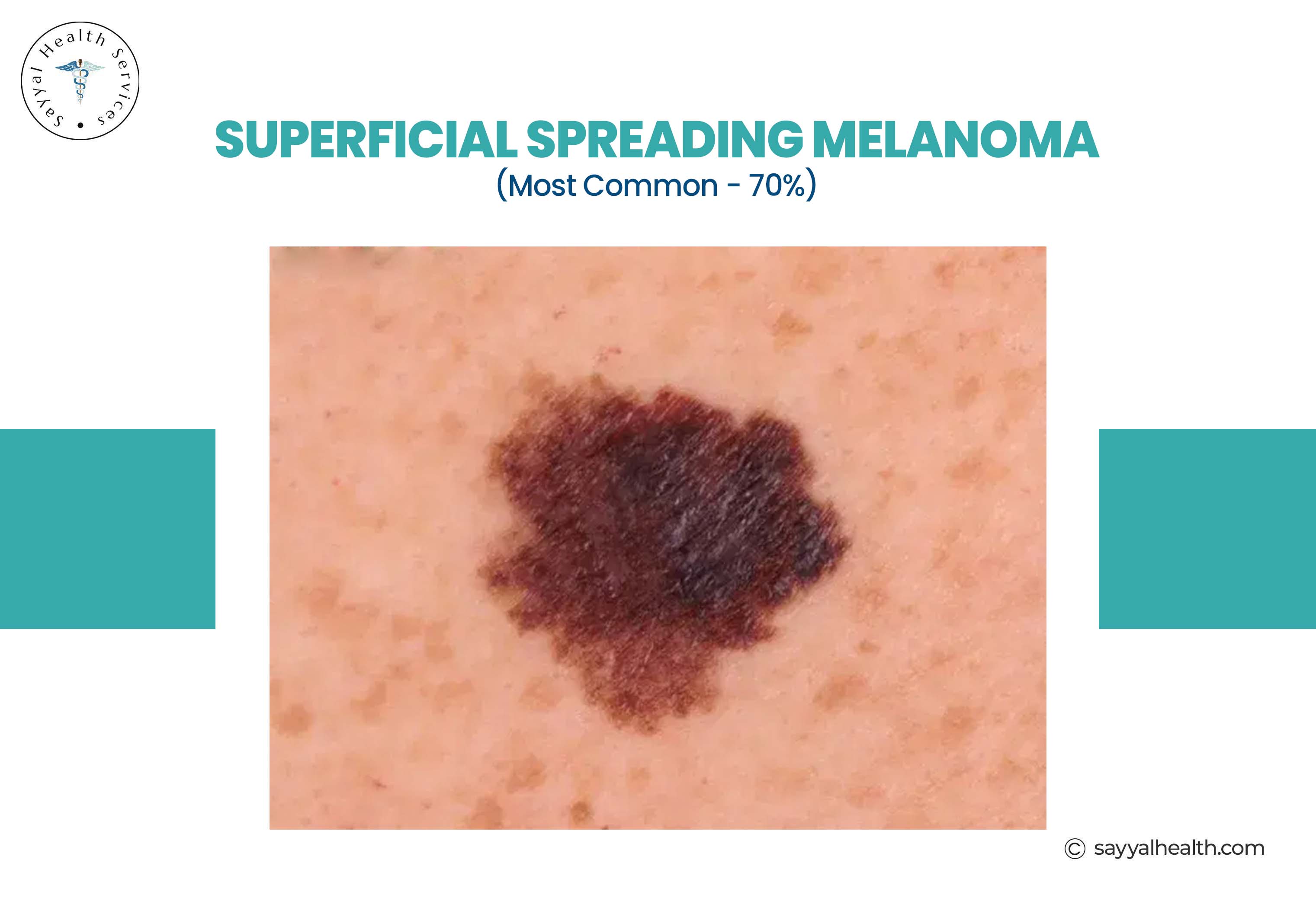 Superficial spreading melanoma - most common type affecting 70% of cases